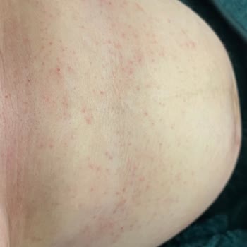 Mustela Çatlak Kremi Alerji Yaptı