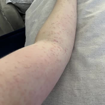 Mustela Çatlak Kremi Alerji Yaptı