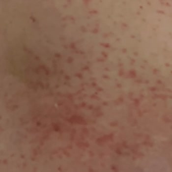 Mustela Çatlak Kremi Alerji Yaptı