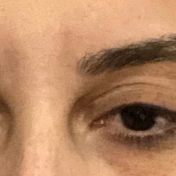 Doktorsitesi.com Botoks Sonrası Göz Kapağı Sorunu!