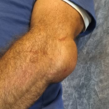 Yasomi Scooter Direksiyon Mandalı Açılıyor