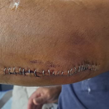 Yasomi Scooter Direksiyon Mandalı Açılıyor