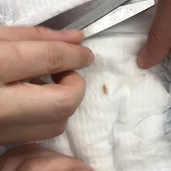 Molfix Bezde Tahta Parçası Çıktı