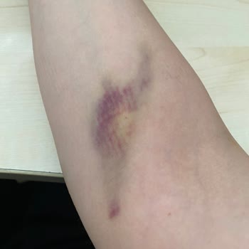 Medipol Sağlık Grubu Sefaköy Hastanesi Hemşirelerinin Vasatlığı