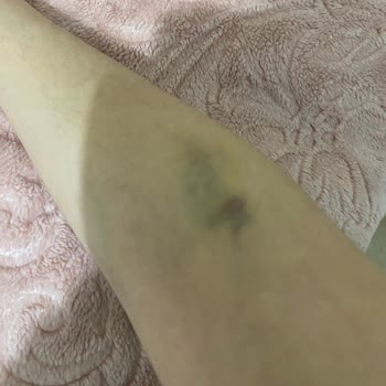 Medipol Sağlık Grubu Sefaköy Hastanesi Hemşirelerinin Vasatlığı