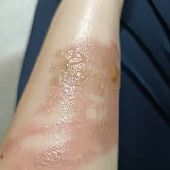 Stanley Termosun Kapağı Patladı Yüzüm Ve Kolum Yandı