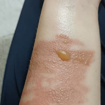 Stanley Termosun Kapağı Patladı Yüzüm Ve Kolum Yandı