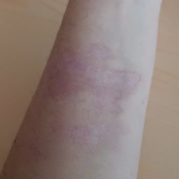 Stanley Termosun Kapağı Patladı Yüzüm Ve Kolum Yandı