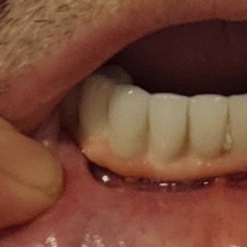 Vera Hastanesi Avcılar'da Diş Tedavisi Sonrası Yaşadığım Sorunlar