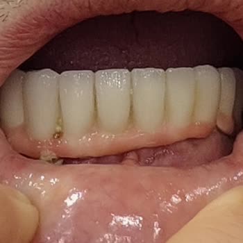 Vera Hastanesi Avcılar'da Diş Tedavisi Sonrası Yaşadığım Sorunlar