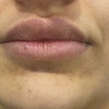 Sade Poliklinik Leke Mezoterapi Tedavisi