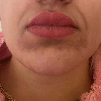 Sade Poliklinik Leke Mezoterapi Tedavisi