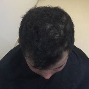 Life Hair Konya Saç Ekimi Sürecinde Yaşadığım Hayal Kırıklığı!