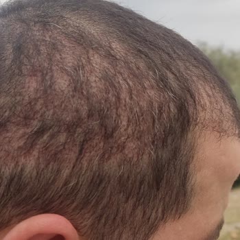 Life Hair Konya Saç Ekimi Sürecinde Yaşadığım Hayal Kırıklığı!