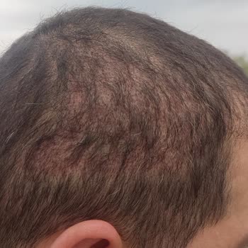 Life Hair Konya Saç Ekimi Sürecinde Yaşadığım Hayal Kırıklığı!