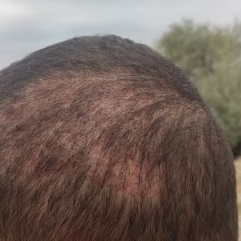 Life Hair Konya Saç Ekimi Sürecinde Yaşadığım Hayal Kırıklığı!