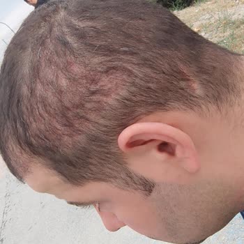 Life Hair Konya Saç Ekimi Sürecinde Yaşadığım Hayal Kırıklığı!