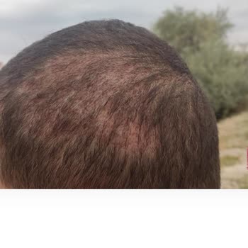 Life Hair Konya Saç Ekimi Sürecinde Yaşadığım Hayal Kırıklığı!