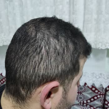 Life Hair Konya Saç Ekimi Sürecinde Yaşadığım Hayal Kırıklığı!