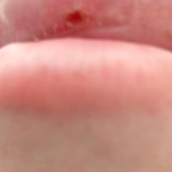 Dr. Suat Okyay Dudak Ve Burun Dolgusu