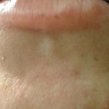 Dr. Suat Okyay Dudak Ve Burun Dolgusu