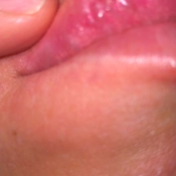 Dr. Suat Okyay Dudak Ve Burun Dolgusu