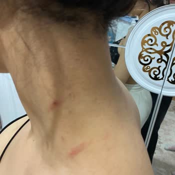 Esteclinice Güzellik Hizmetleri (Bağcılar) Yanık Oldu