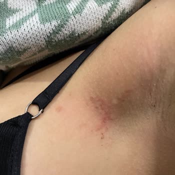 Esteclinice Güzellik Hizmetleri (Bağcılar) Yanık Oldu