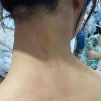 Esteclinice Güzellik Hizmetleri (Bağcılar) Yanık Oldu