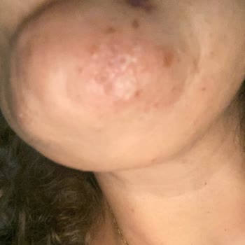 Quenzz Estetik Yüzümü Yaktı Kalıcı İz Bıraktı