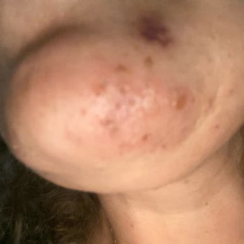 Quenzz Estetik Yüzümü Yaktı Kalıcı İz Bıraktı