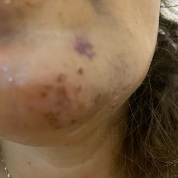 Quenzz Estetik Yüzümü Yaktı Kalıcı İz Bıraktı