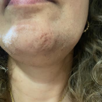 Quenzz Estetik Yüzümü Yaktı Kalıcı İz Bıraktı