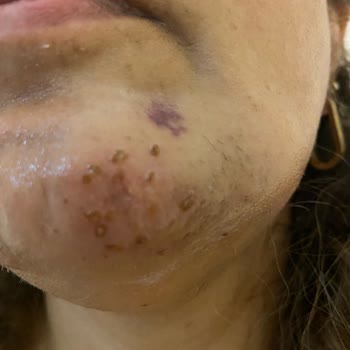 Quenzz Estetik Yüzümü Yaktı Kalıcı İz Bıraktı