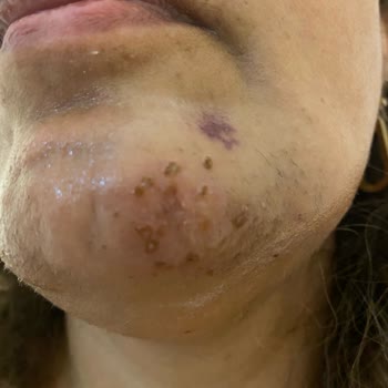 Quenzz Estetik Yüzümü Yaktı Kalıcı İz Bıraktı