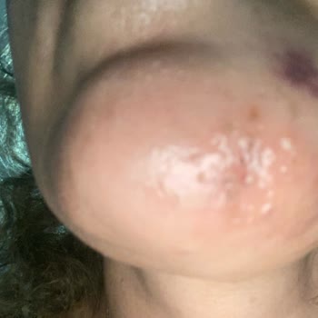 Quenzz Estetik Yüzümü Yaktı Kalıcı İz Bıraktı