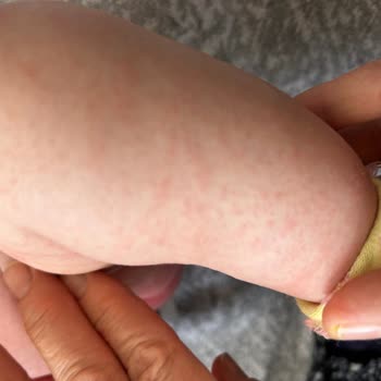 Evolvia RP Mama Pişik Kızarıklık