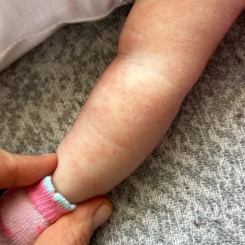 Evolvia RP Mama Pişik Kızarıklık