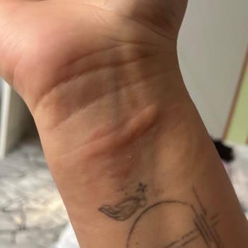 Apple Watch Alerji Yaptı.