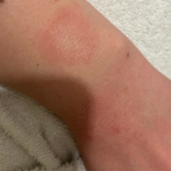 Apple Watch Alerji Yaptı.