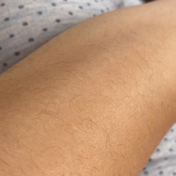 Adolya Estetik İki Yıllık Lazer Tedavisinde Beklenen Sonuç Alamadım!