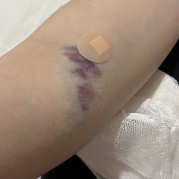 Türkiye Hastanesi Damarımı Patlattılar. Serum Derimin Altına Sızdı