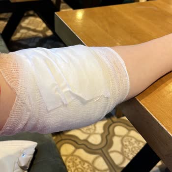 Türkiye Hastanesi Damarımı Patlattılar. Serum Derimin Altına Sızdı