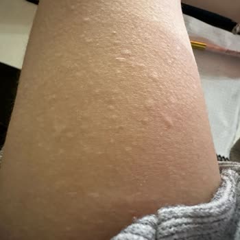 Çekmeköy Tıp Merkezi Cildiye Güneş Lekesine Bile Tanı Koyamıyor