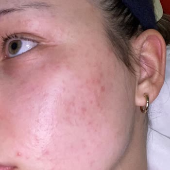 Watsons Banila Co Zero Yüzümü Mahvetti