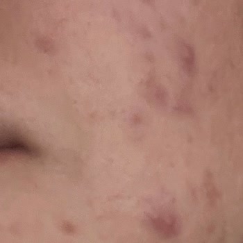 Forever Güzellik Salonu Cilt Bakımı Sonrası Yaşadığım Olumsuz Deneyim