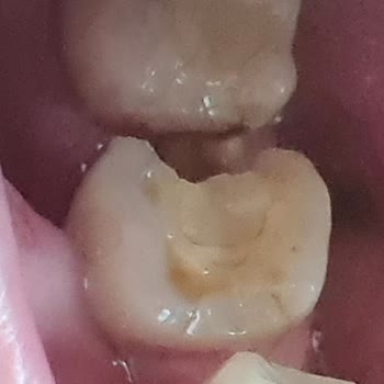 Areni Cappadocia Restaurant Yüzünden Dişim Kırıldı