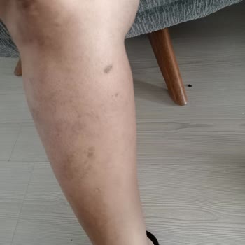 Glam Life Güzellik & Cilt Bakım Merkezi Lazerle Bütün Vücudumu Yaktılar