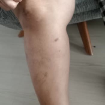 Glam Life Güzellik & Cilt Bakım Merkezi Lazerle Bütün Vücudumu Yaktılar