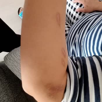 Glam Life Güzellik & Cilt Bakım Merkezi Lazerle Bütün Vücudumu Yaktılar